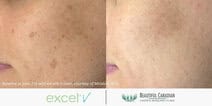brown spots pigmentation treatment before and after with excel V laser - available in Surrey Vancouver