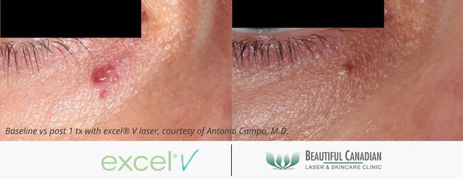 angioma mole removal before and after with excel V laser - available in Vancouver Surrey