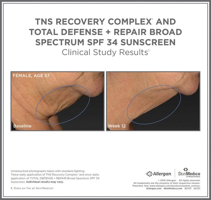 SkinMedica Before and After photo of TNS Recovery Complex with Total Defense and Repair SPF 34 - high end skincare results