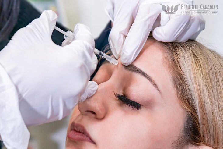 Vancouver Botox for glabellar frown lines in forehead - centre injection