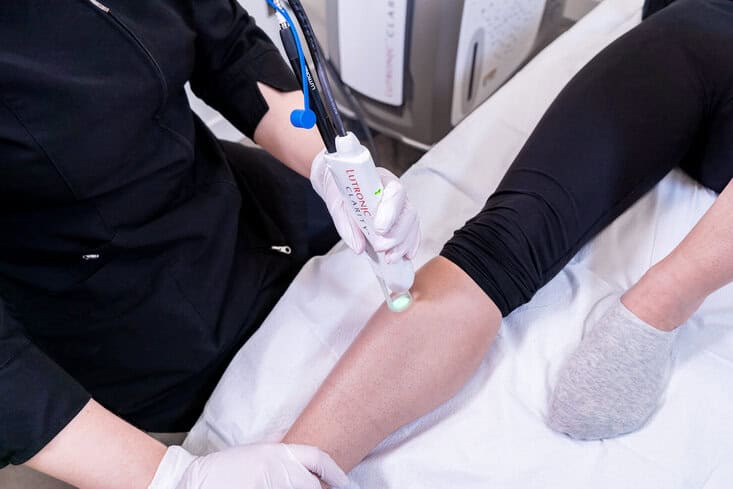 Surrey Vancouver laser hair removal on leg of female patient with Clarity laser beam