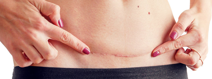 Surgical c-section scar on woman abdomen for scar revision assessment