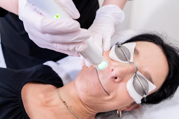 Surrey facial laser hair removal on upper lip moustache removal