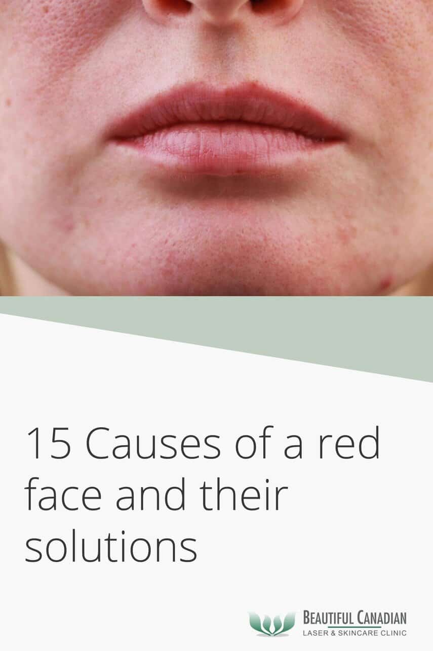What Causes Red Faces
