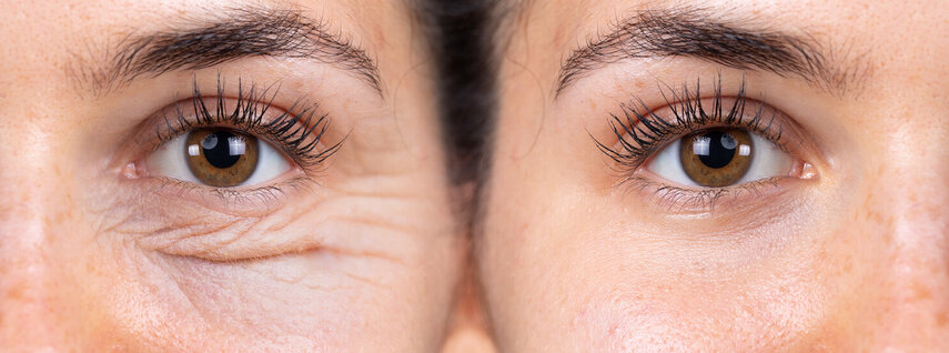 Hydroquinone for Dark Eye Circles: Effective Brightening Solution