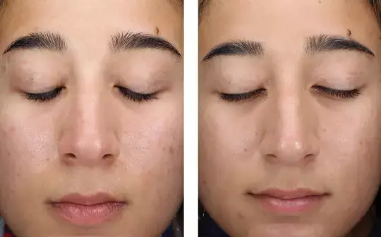 Official Skinbetter photograph after 8 weeks of nightly use. Individual results vary.