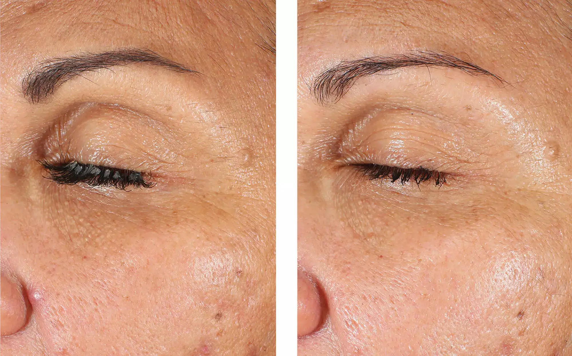 Official Skinbetter EyeMax photograph after 8 weeks of nightly use. Individual results vary.